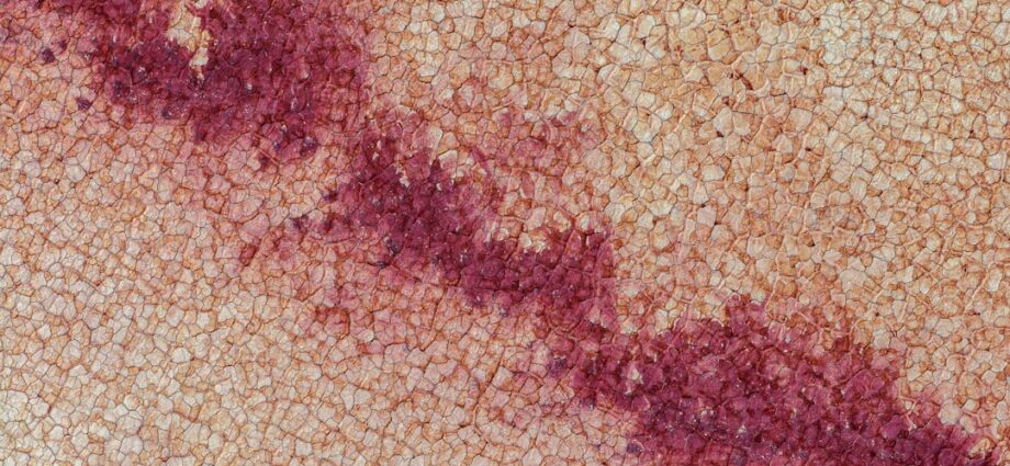 découvrez les symptômes de la varicelle, une infection virale courante, et comment les reconnaître rapidement pour mieux gérer la maladie.