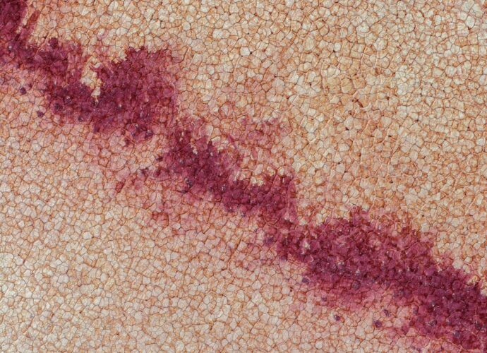 découvrez les symptômes de l'herpès, leurs signes courants et comment les reconnaître pour mieux gérer cette infection virale.