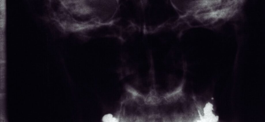 découvrez les symptômes de l'hyperthyroïdie, incluant la perte de poids, les palpitations et la fatigue, pour mieux comprendre cette condition thyroïdienne.