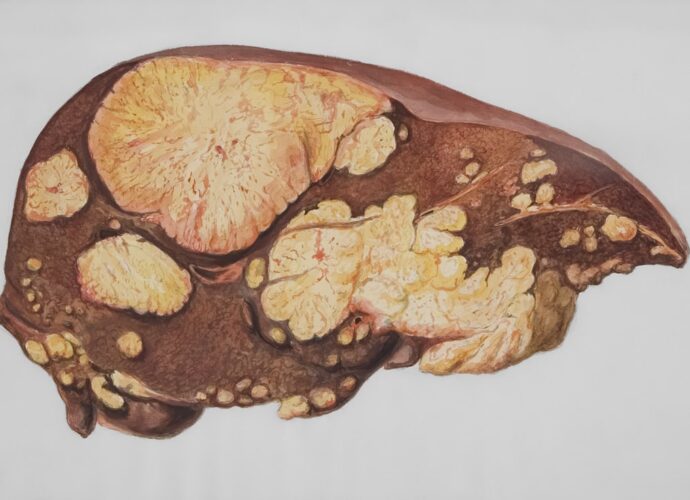 découvrez les symptômes du cancer du foie, comment les reconnaître tôt et les signes à surveiller pour une prise en charge rapide.