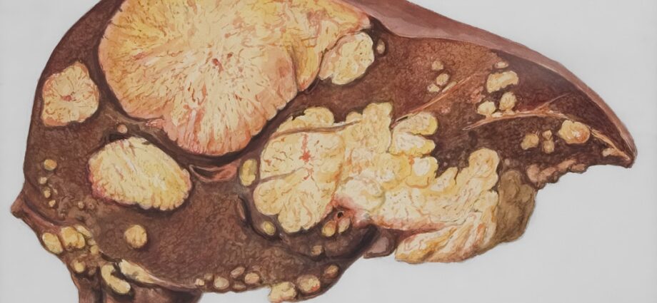 découvrez les symptômes du cancer du foie, comment les reconnaître tôt et les signes à surveiller pour une prise en charge rapide.