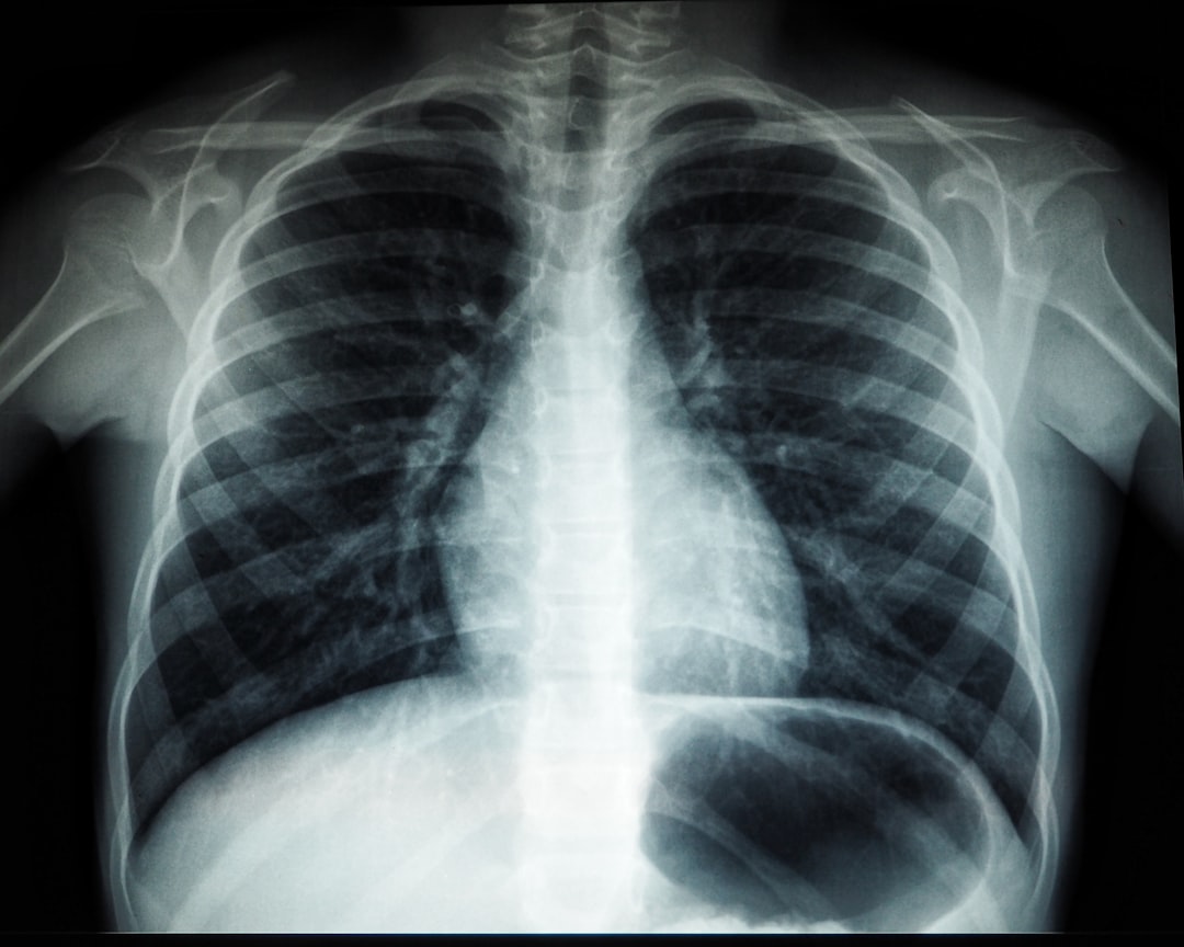 découvrez les symptômes du cancer du poumon pour une détection précoce et un traitement efficace.