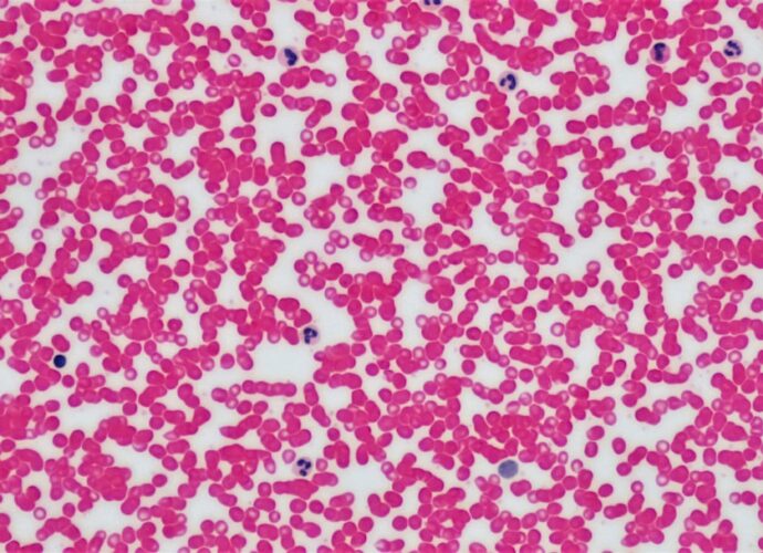 découvrez les symptômes de la maladie de lyme, une infection transmise par les tiques, incluant fièvre, fatigue, éruptions cutanées et douleurs articulaires.