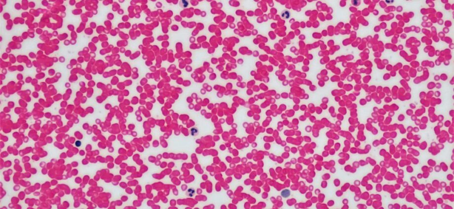 découvrez les symptômes de la maladie de lyme, une infection transmise par les tiques, incluant fièvre, fatigue, éruptions cutanées et douleurs articulaires.
