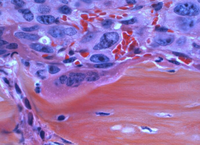 découvrez les principaux symptômes du cancer du pancréas pour une détection précoce et un meilleur suivi médical.