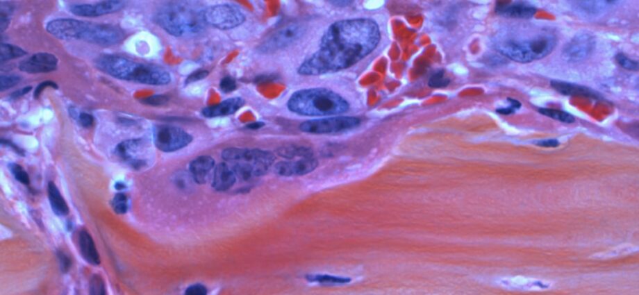 découvrez les principaux symptômes du cancer du pancréas pour une détection précoce et un meilleur suivi médical.