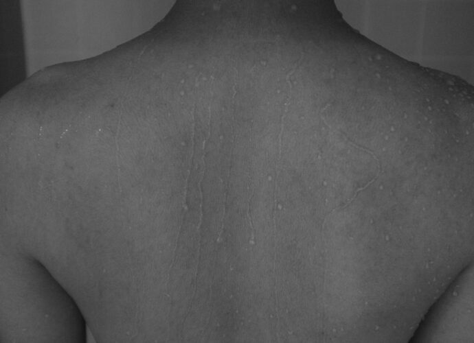 découvrez les symptômes du zona, une infection virale caractérisée par une éruption cutanée douloureuse. apprenez à reconnaître les signes précoces pour un traitement rapide.
