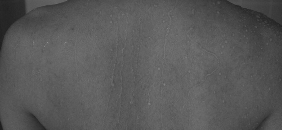 découvrez les symptômes du zona, une infection virale caractérisée par une éruption cutanée douloureuse. apprenez à reconnaître les signes précoces pour un traitement rapide.
